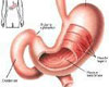 慢性胃溃疡常识